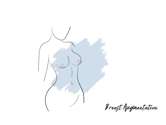 breast augmentation Best breast augmentation in Gachibowli