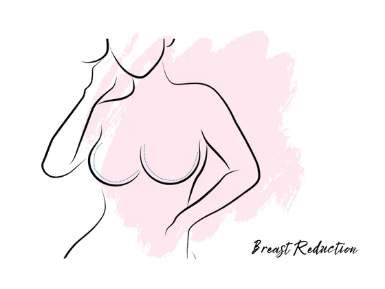 Breast Reduction Surgeon Best Breast Reduction Surgeon in Gachibowli