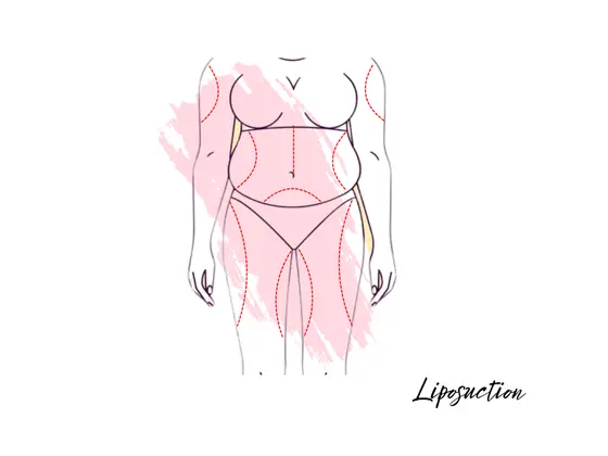 Liposuction Surgeries Liposuction Surgeries in Gachibowli
